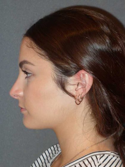 Rhinoplasty Before & After Patient #867