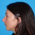 Rhinoplasty Before & After Patient #878