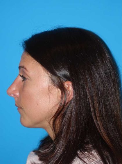 Rhinoplasty Before & After Patient #878