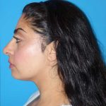 Rhinoplasty Before & After Patient #887