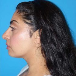 Rhinoplasty Before & After Patient #887