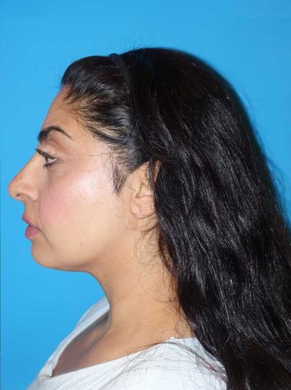 Rhinoplasty Before & After Patient #887