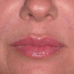 Juv&eacute;derm - Lips Before & After Patient #659
