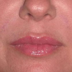 Juvéderm - Lips Before & After Patient #659