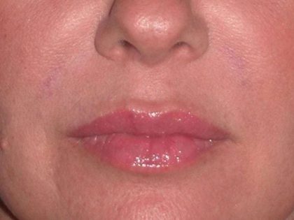 Juvéderm - Lips Before & After Patient #659