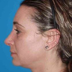 Rhinoplasty Before & After Patient #898