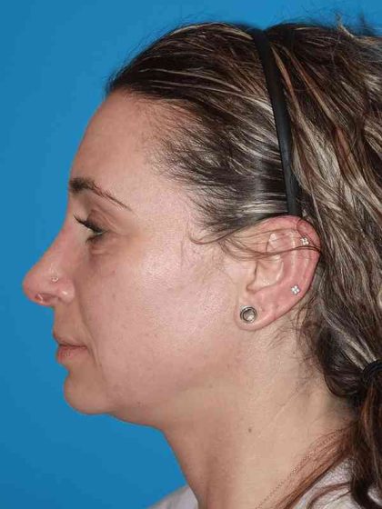 Rhinoplasty Before & After Patient #898