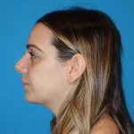 Rhinoplasty Before & After Patient #909