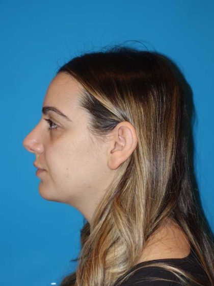 Rhinoplasty Before & After Patient #909
