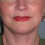 Deep Plane Lower Face & Neck Lift Before & After Patient #936
