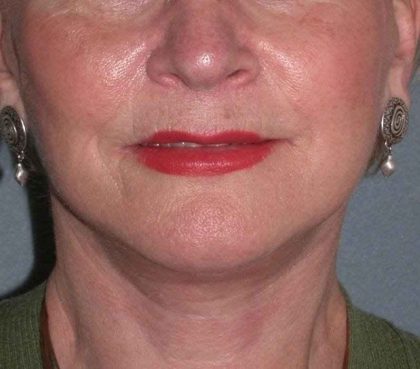 Deep Plane Lower Face & Neck Lift Before & After Patient #936