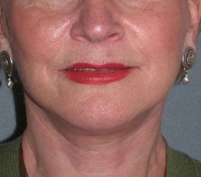 Deep Plane Lower Face & Neck Lift Before & After Patient #936