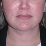 Deep Plane Lower Face & Neck Lift Before & After Patient #947