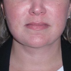 Deep Plane Lower Face & Neck Lift Before & After Patient #947