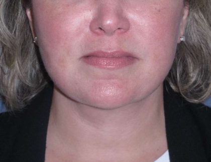 Deep Plane Lower Face & Neck Lift Before & After Patient #947