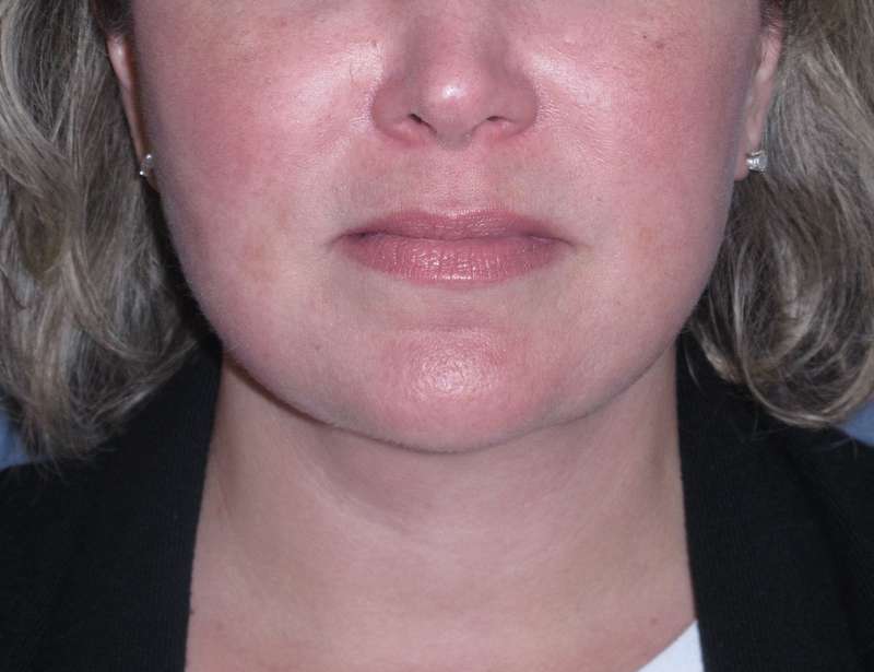 Deep Plane Lower Face & Neck Lift Before & After Patient #947