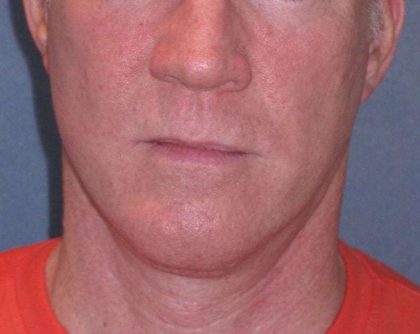Deep Plane Mini Lift & Neck Lift Before & After Patient #965