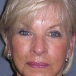 Deep Plane Mini Lift & Neck Lift Before & After Patient #972