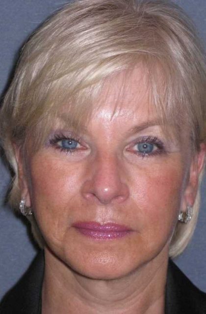 Deep Plane Mini Lift & Neck Lift Before & After Patient #972
