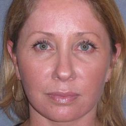 Deep Plane Mini Lift & Neck Lift Before & After Patient #981