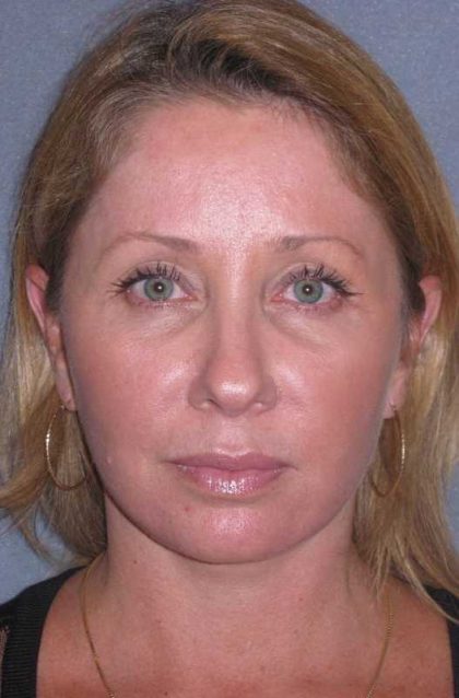Deep Plane Mini Lift & Neck Lift Before & After Patient #981