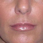 Juv&eacute;derm - Lips Before & After Patient #662