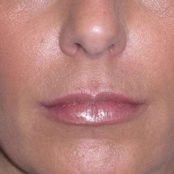 Juvéderm - Lips Before & After Patient #662