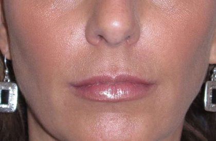 Juvéderm - Lips Before & After Patient #662