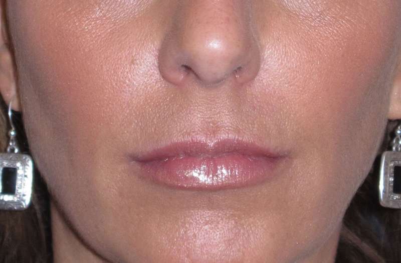 Juv&eacute;derm - Lips Before & After Patient #662