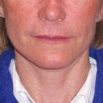 Deep Plane Mini Lift & Neck Lift Before & After Patient #988