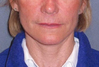Deep Plane Mini Lift & Neck Lift Before & After Patient #988