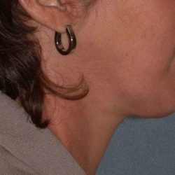 Neck Lift Before & After Patient #1002