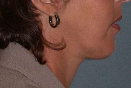 Neck Lift Before & After Patient #1002
