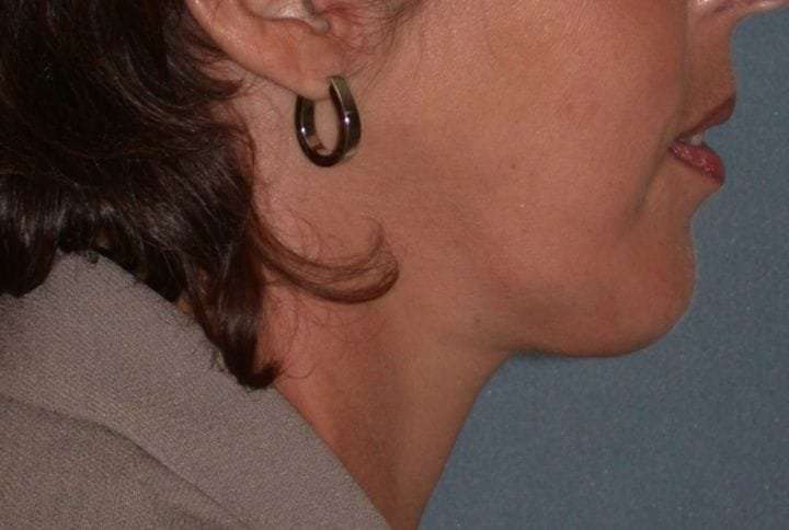 Neck Lift Before & After Patient #1002