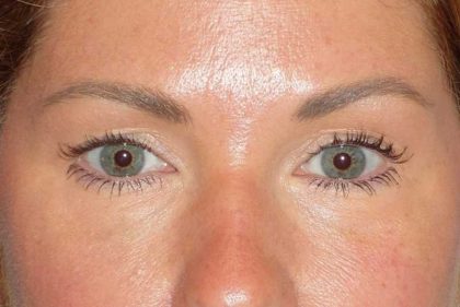 Juvéderm - Tear Troughs Before & After Patient #648