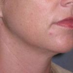Neck Lift Before & After Patient #1007