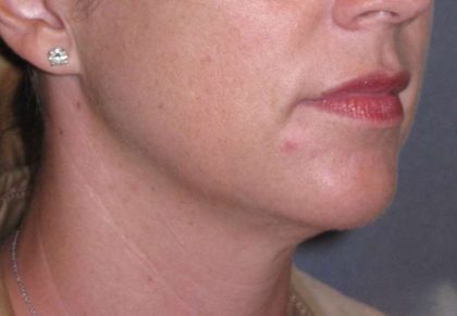 Neck Lift Before & After Patient #1007