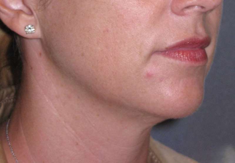 Neck Lift Before & After Patient #1007
