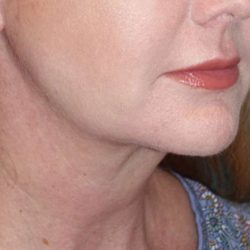 Neck Lift Before & After Patient #1018