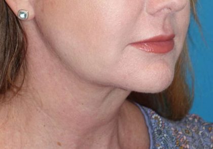 Neck Lift Before & After Patient #1018
