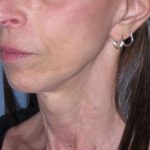 Deep Plane Mini Lift & Neck Lift Before & After Patient #1023