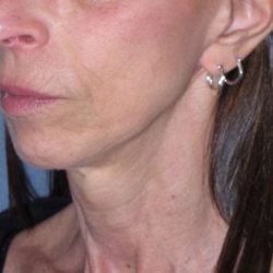 Deep Plane Mini Lift & Neck Lift Before & After Patient #1023