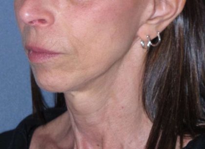 Deep Plane Mini Lift & Neck Lift Before & After Patient #1023