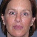 Deep Plane Mini Lift & Neck Lift Before & After Patient #1030