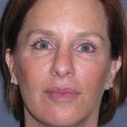 Deep Plane Mini Lift & Neck Lift Before & After Patient #1030