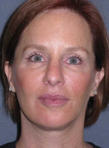 Deep Plane Mini Lift & Neck Lift Before & After Patient #1030