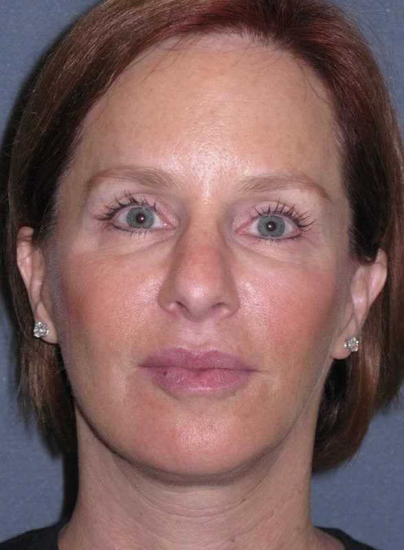 Deep Plane Mini Lift & Neck Lift Before & After Patient #1030