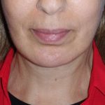Deep Plane Lower Face & Neck Lift Before & After Patient #1041