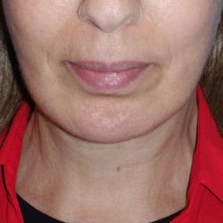 Deep Plane Lower Face & Neck Lift Before & After Patient #1041