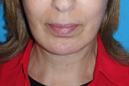 Deep Plane Lower Face & Neck Lift Before & After Patient #1041